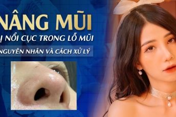 Nâng mũi bị nổi cục trong lỗ mũi: Nguyên nhân và cách xử lý